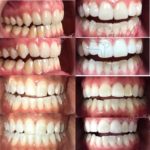 Beaming White Teeth Whitening at Smoothe